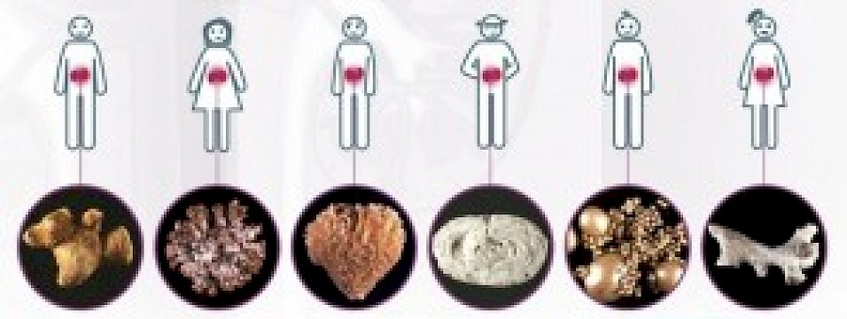 Böbrek Taşları Hakkında Her Şey – II