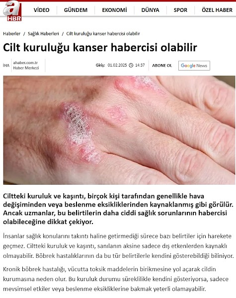 Cilt kuruluğu kanser habercisi olabilir.